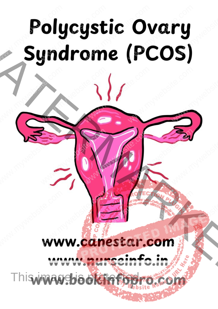 Polycystic ovary syndrome (PCOS) - Definition, types, causes, signs and symptoms, diagnosis, treatment and prevention